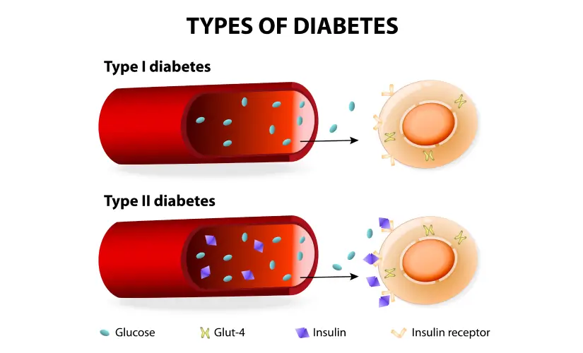 Types Of Diabetes